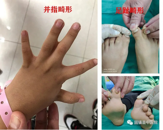 固镇县卫健委中医院外二科成功开展一例并指畸形矫形术