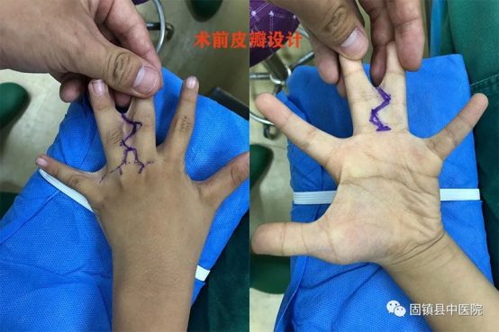 固镇县卫健委中医院外二科成功开展一例并指畸形矫形术